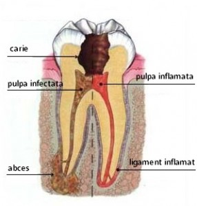 tooth-abcess